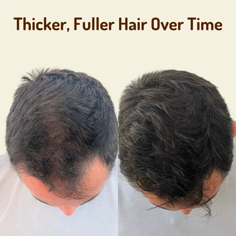 RootRevival Crown - The red light therapy cap built for men noticing early crown thinning.